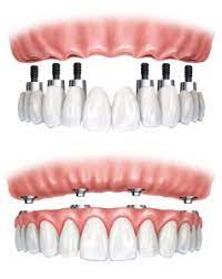 The Complete Guide to Garland Dental Implants and Their Amazing Benefits!